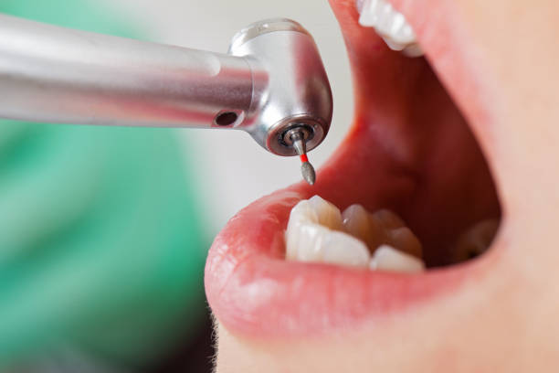Best Broken or Chipped Tooth Repair in Lagrange, OH